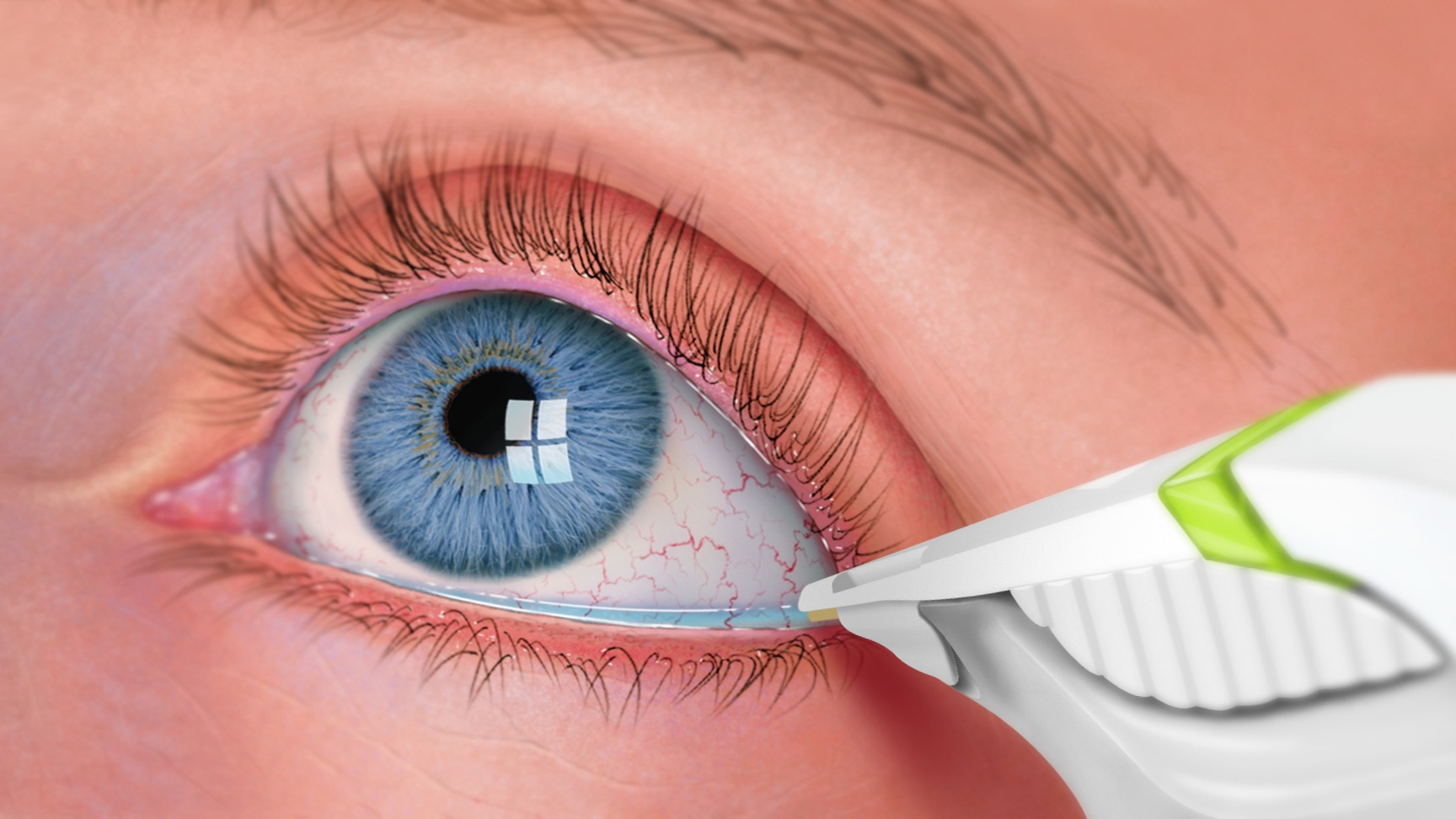 Eye treatment